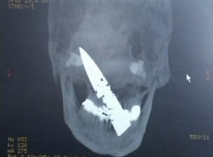 Knife in Chinese man's head.